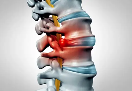 Bel Fıtığına Pilates İyi Gelir mi?